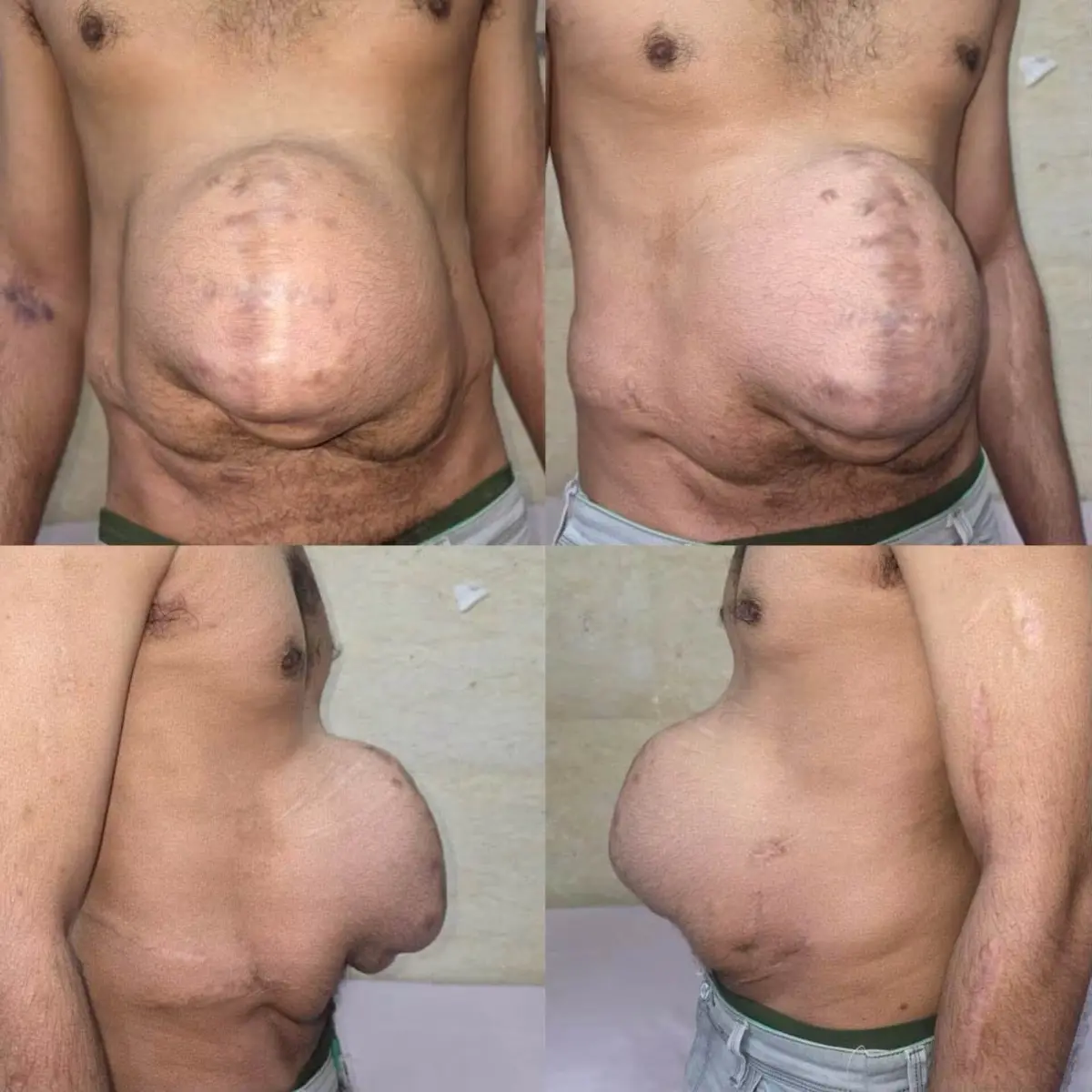 في سابقة هي الأولى من نوعها.. نجاح جراحي معقد بمستشفيات جامعة بني سويف لاستئصال فتق ضخم وإعادة أحشاء البطن باستخدام تقنية «حقن البوتكس» المبتكرة دون دخول الرعاية المركزة
